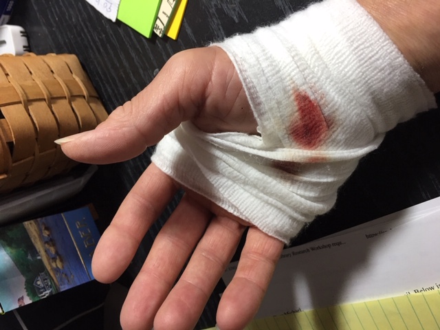 UH-OH! (nasty table saw hand injury)-hand2-jpg